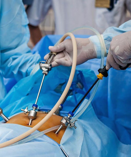 Instrumentos de Laparoscopía